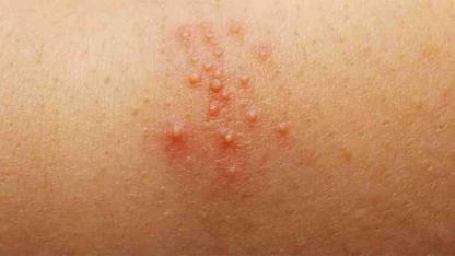 Groin Irritation Explained: Why Ingrown Hairs Happen and How to Prevent Them