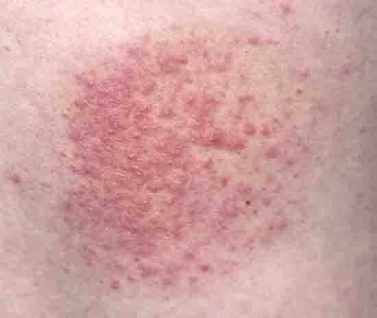 Groin Irritation Explained: Why Ingrown Hairs Happen and How to Prevent Them