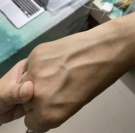 Visible Veins Suddenly Appearing? Here's When They're Normal and When to Worry